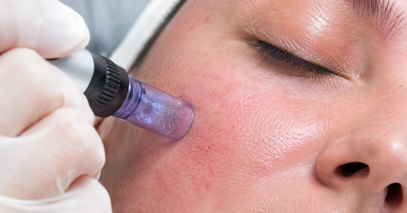 Como Potencializar Dermocosméticos com Microagulhamento
